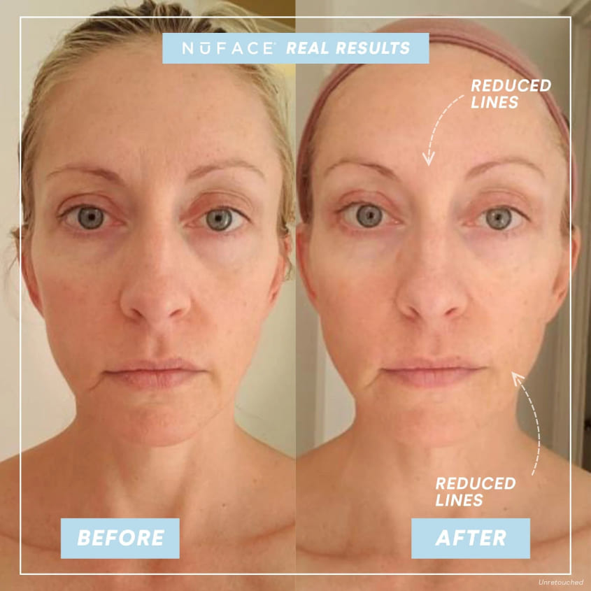 Trinity Wrinkle Reducer Attachment