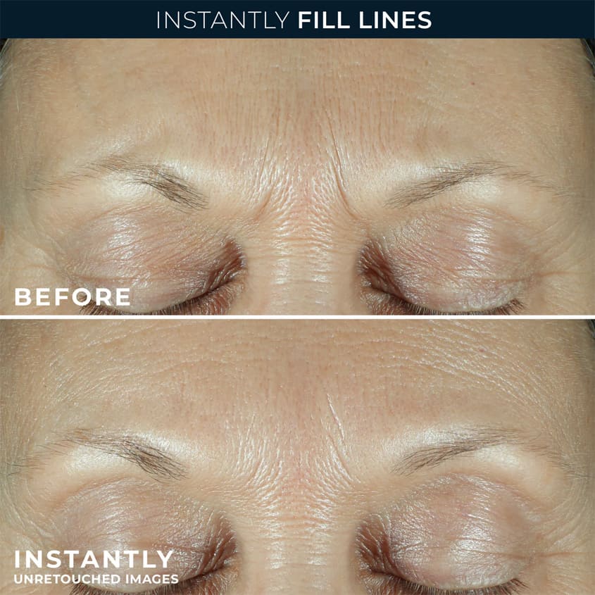 Derm Correxion® Fill + Treat Serum
