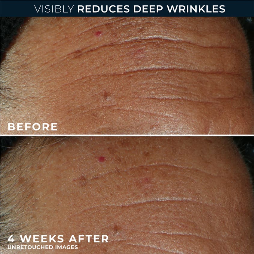 Derm Correxion® Fill + Treat Serum