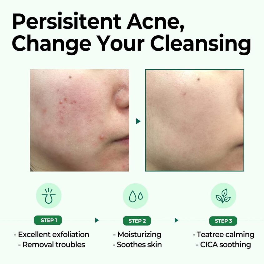 SOME BY MI 30 DAYS MIRACLE CLEANSING BAR 106G – online store